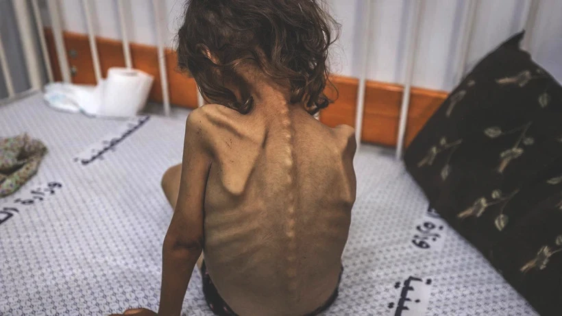 Bu Fotoğraflara Bakmaya Yürek Dayanmaz: Gazze'de Açlık Can Almaya Devam Ediyor! Minik Bedenler Göz Göre Ölüyor - Resim: 7